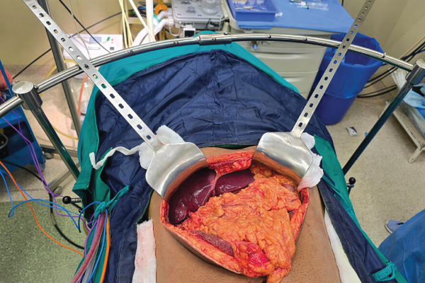 Haribhakti Retractor